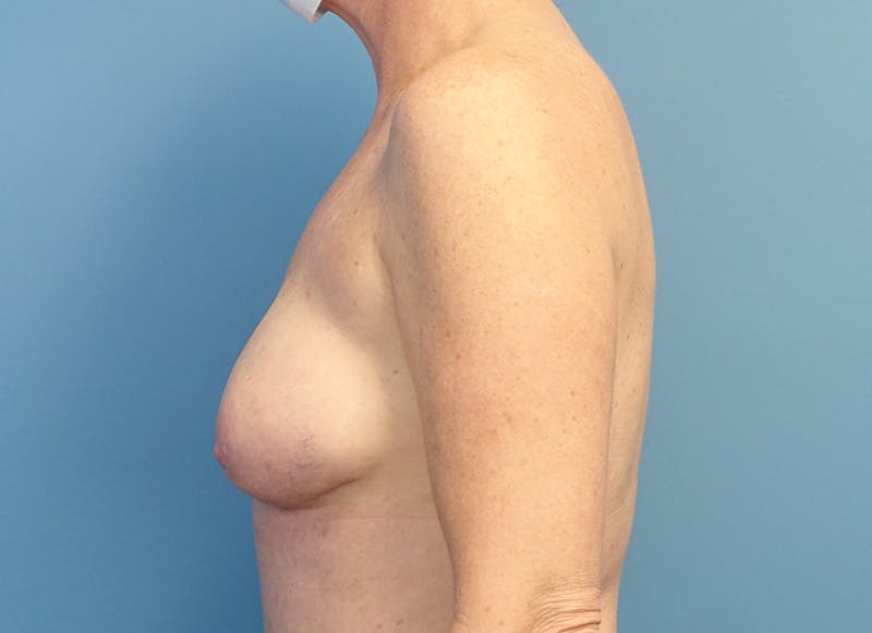 Hybrid Reconstruction Before & After Gallery - Patient 179250602 - Image 2