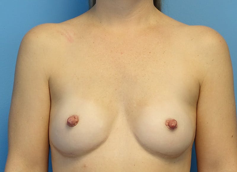 Hybrid Reconstruction Before & After Gallery - Patient 179250603 - Image 6