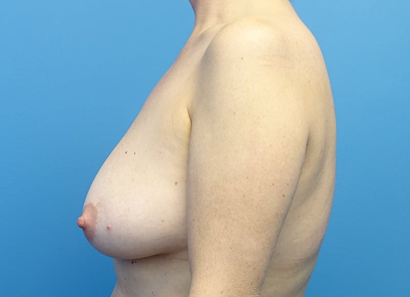 Breast Lift Before & After Gallery - Patient 179310050 - Image 1