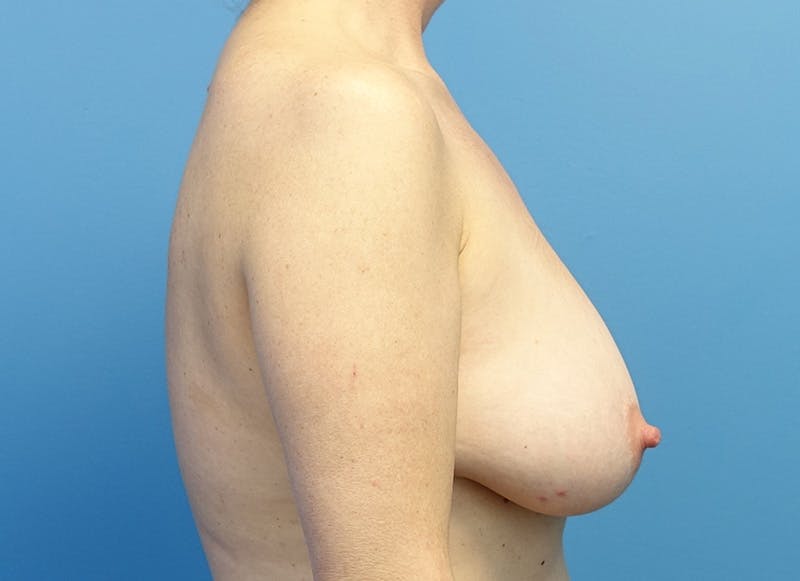 Breast Lift Before & After Gallery - Patient 179310050 - Image 7