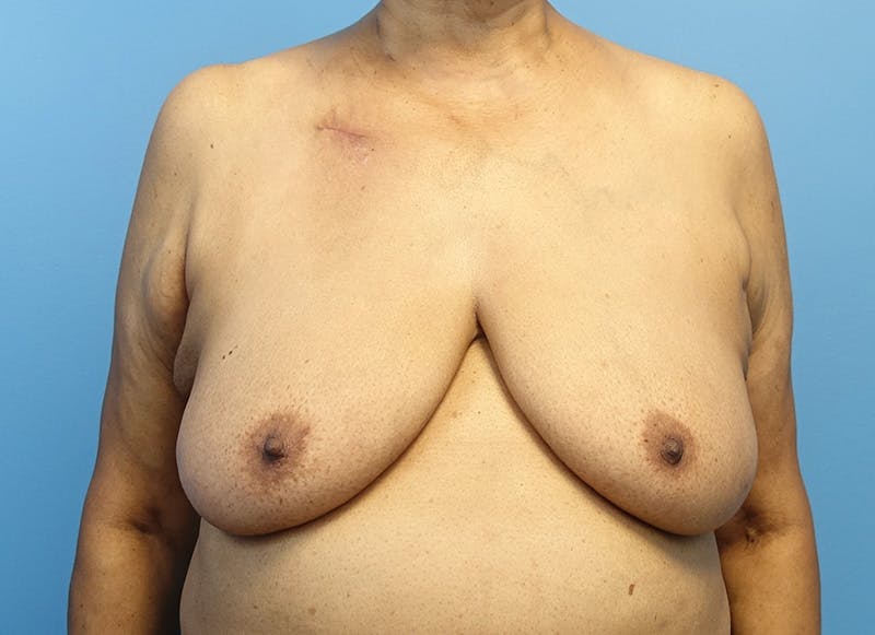 Breast Lift Before & After Gallery - Patient 179310052 - Image 5