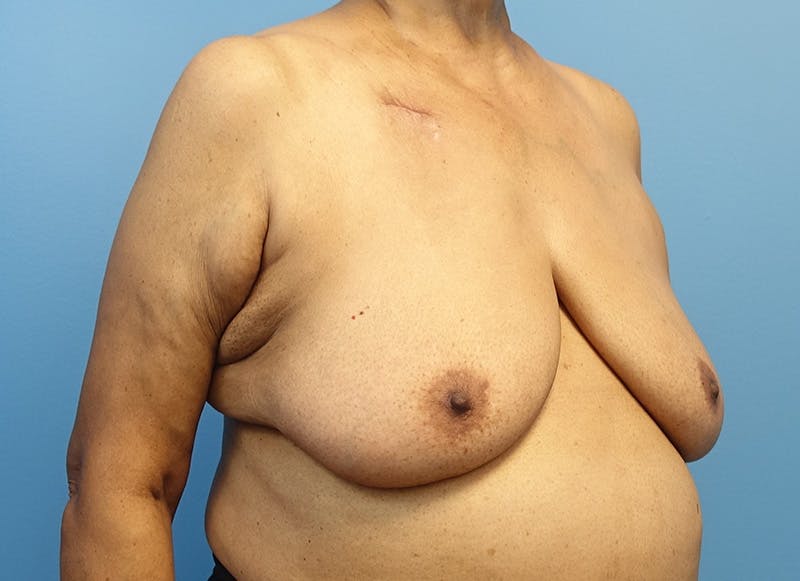 Breast Lift Before & After Gallery - Patient 179310052 - Image 7