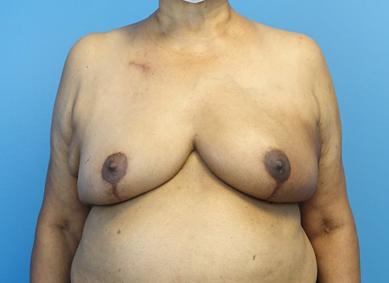 Breast Lift Before & After Gallery - Patient 179310052 - Image 6