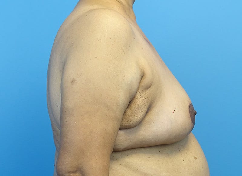 Breast Lift Before & After Gallery - Patient 179310052 - Image 10