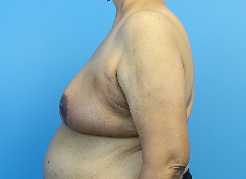 Breast Lift Before & After Gallery - Patient 179310052 - Image 2