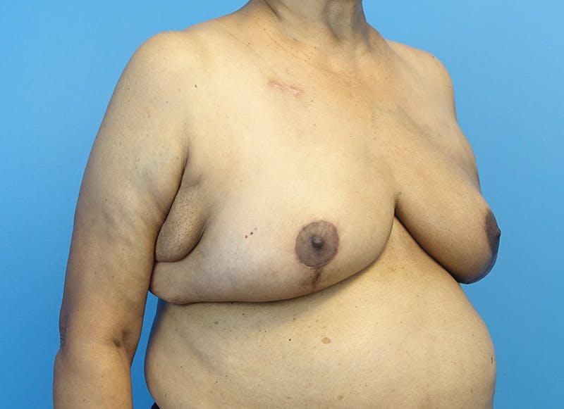 Breast Lift Before & After Gallery - Patient 179310052 - Image 8