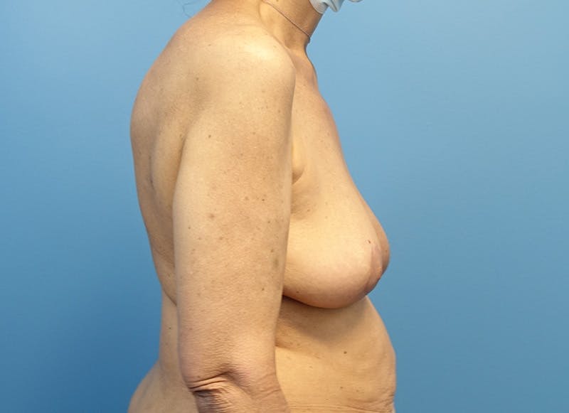 Breast Lift Before & After Gallery - Patient 174341527 - Image 8