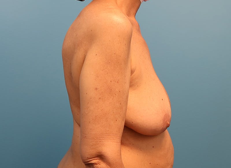 Breast Lift Before & After Gallery - Patient 174341527 - Image 7