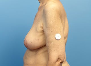Breast Lift Before & After Gallery - Patient 242978 - Image 2