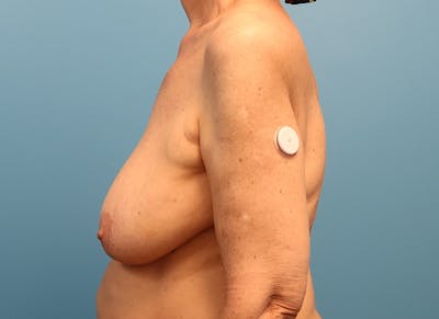 Breast Lift Before & After Gallery - Patient 242978 - Image 1