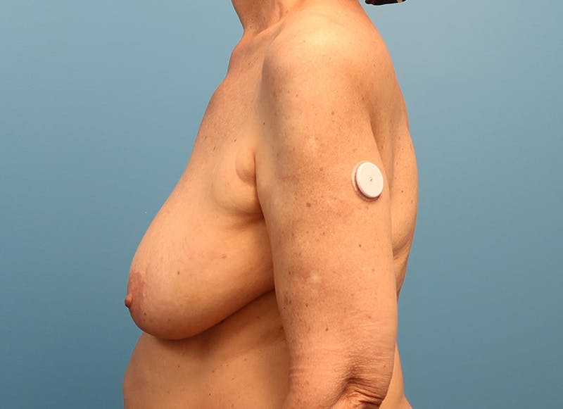 Breast Lift Before & After Gallery - Patient 174341527 - Image 1