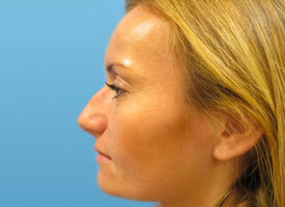 Rhinoplasty Before & After Gallery - Patient 112338607 - Image 1