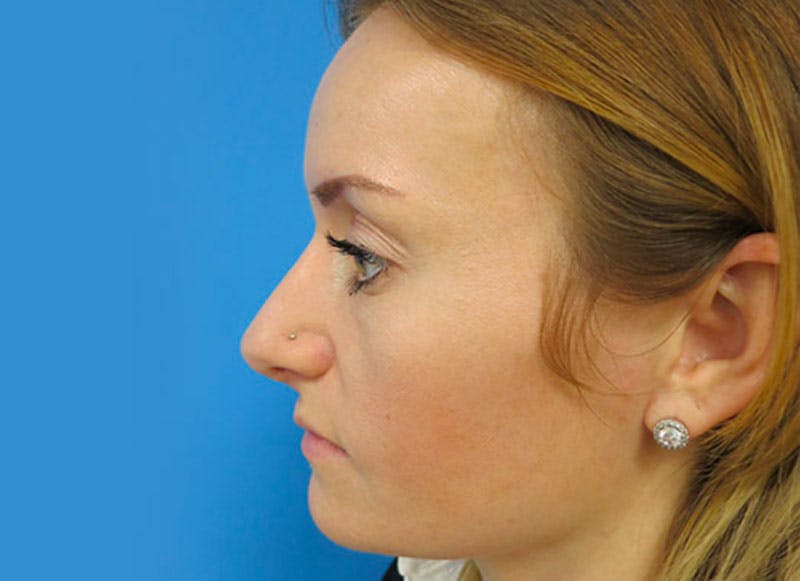 Rhinoplasty Before & After Gallery - Patient 112338607 - Image 2