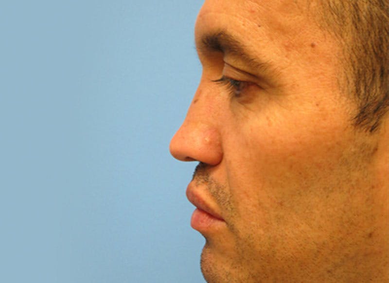 Rhinoplasty Before & After Gallery - Patient 112338616 - Image 1