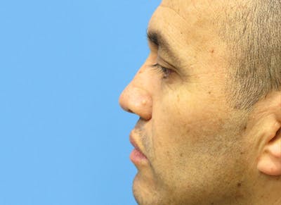 Rhinoplasty Before & After Gallery - Patient 112338616 - Image 2