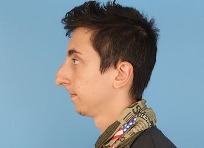 Rhinoplasty Before & After Gallery - Patient 414552 - Image 1