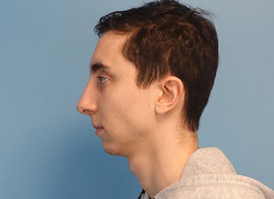 Rhinoplasty Before & After Gallery - Patient 414552 - Image 2