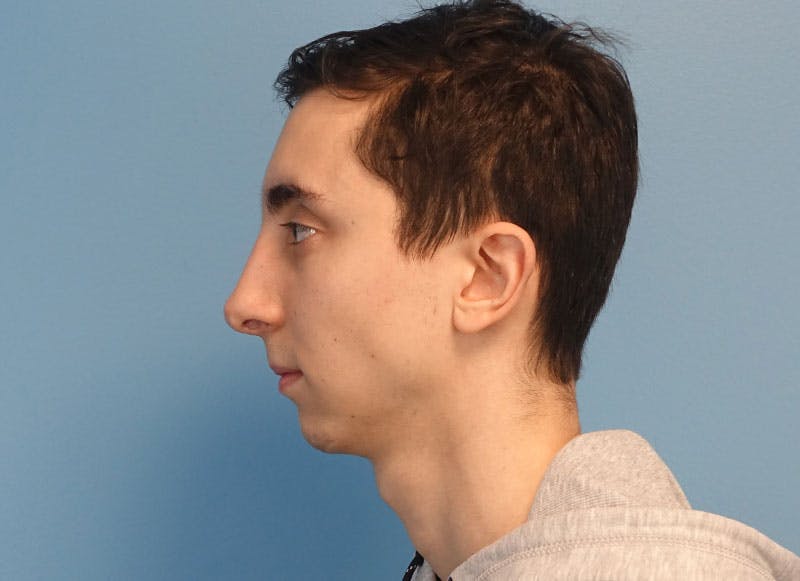 Rhinoplasty Before & After Gallery - Patient 414552 - Image 2