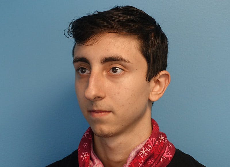 Rhinoplasty Before & After Gallery - Patient 414552 - Image 3
