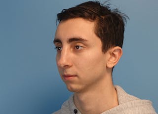 Rhinoplasty Before & After Gallery - Patient 414552 - Image 4