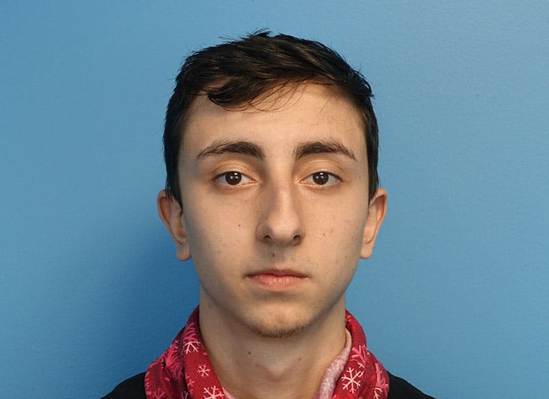 Rhinoplasty Before & After Gallery - Patient 414552 - Image 5