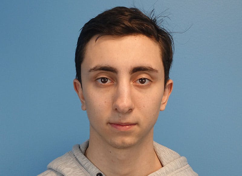 Rhinoplasty Before & After Gallery - Patient 414552 - Image 6