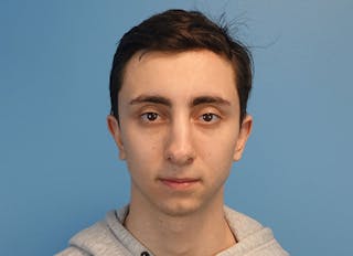 Rhinoplasty Before & After Gallery - Patient 414552 - Image 6