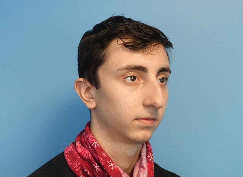 Rhinoplasty Before & After Gallery - Patient 414552 - Image 7