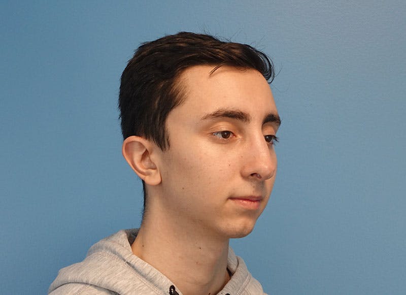 Rhinoplasty Before & After Gallery - Patient 414552 - Image 8