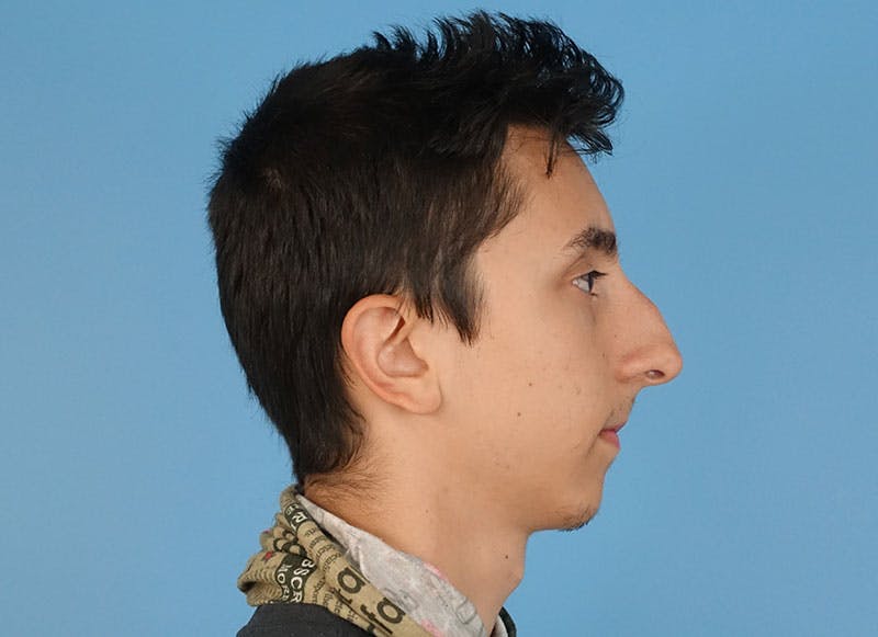 Rhinoplasty Before & After Gallery - Patient 414552 - Image 9