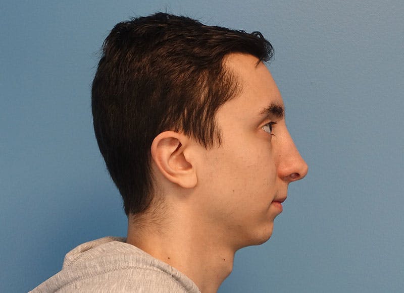 Rhinoplasty Before & After Gallery - Patient 121727056 - Image 10