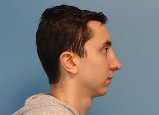 Rhinoplasty Before & After Gallery - Patient 414552 - Image 10