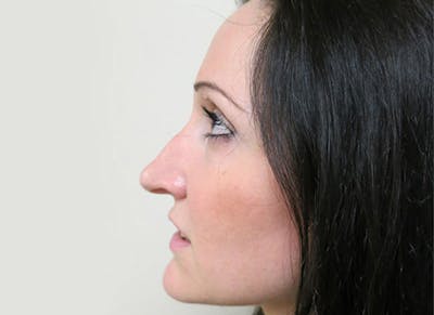 Rhinoplasty Before & After Gallery - Patient 112338619 - Image 1