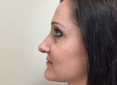 after image of a rhinoplasty