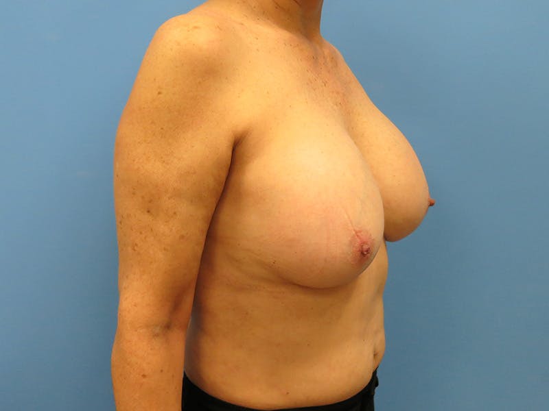Implant Removal Before & After Gallery - Patient 112338624 - Image 7