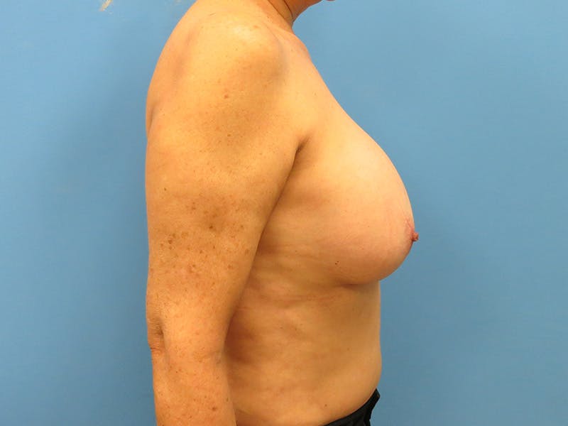 Implant Removal Before & After Gallery - Patient 112338624 - Image 9