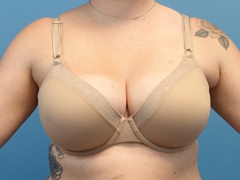 Axillary Breast Removal Before & After Gallery - Patient 265427 - Image 1