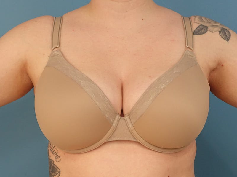 Axillary Breast Removal Before & After Gallery - Patient 265427 - Image 2