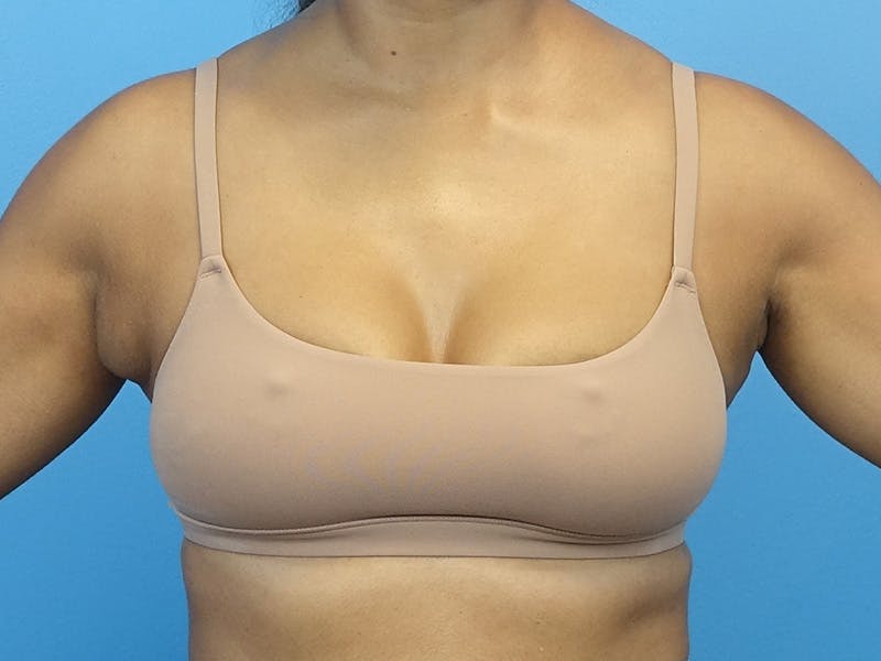 Axillary Breast Removal Before & After Gallery - Patient 245256 - Image 1
