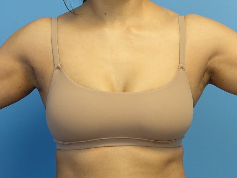 Axillary Breast Removal Before & After Gallery - Patient 245256 - Image 2