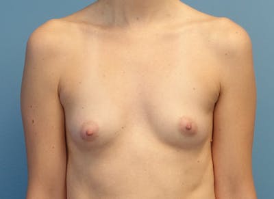 Augmentation Before & After Gallery - Patient 224643 - Image 5