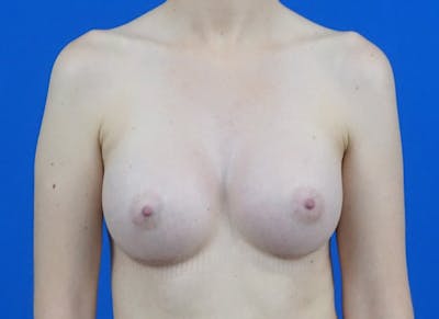 Augmentation Before & After Gallery - Patient 224643 - Image 6