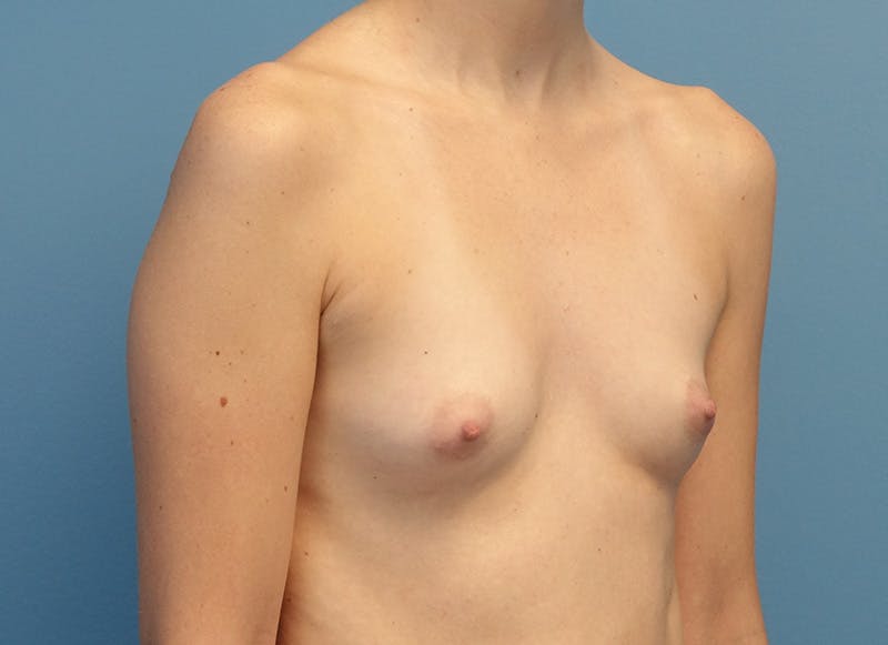 Augmentation Before & After Gallery - Patient 224643 - Image 7