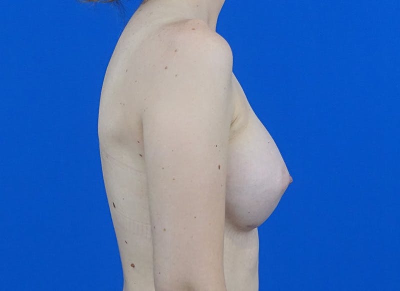 Augmentation Before & After Gallery - Patient 224643 - Image 10