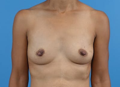 Augmentation Before & After Gallery - Patient 328022 - Image 5