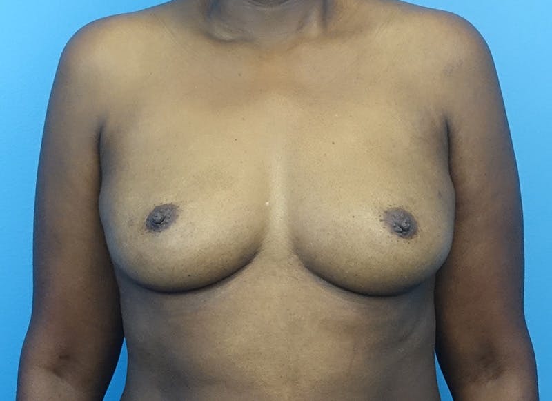 Flap Reconstruction Gallery Before & After Gallery - Patient 845593 - Image 5