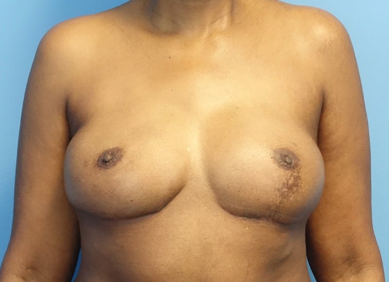 Flap Reconstruction Gallery Before & After Gallery - Patient 845593 - Image 6