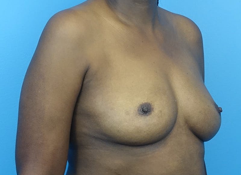 Flap Reconstruction Gallery Before & After Gallery - Patient 845593 - Image 7