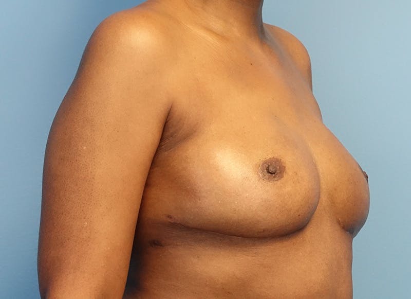 Flap Reconstruction Gallery Before & After Gallery - Patient 845593 - Image 8