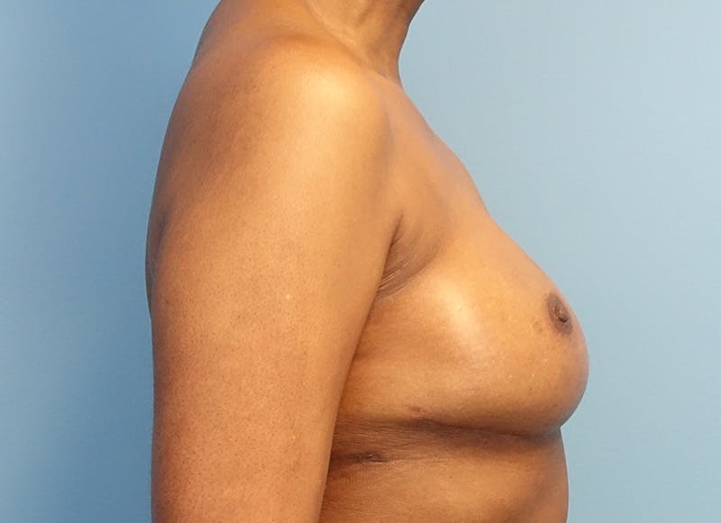 Flap Reconstruction Gallery Before & After Gallery - Patient 845593 - Image 10
